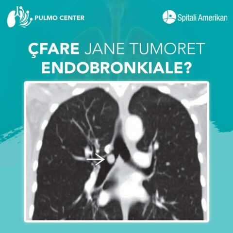 Tumoret endobronkiale